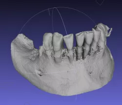 Mandibule DICOM 1