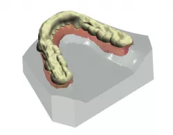 Splint Design  Free 3D print model