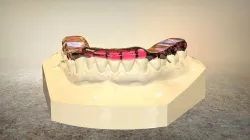 Digital Tanner Splint Orthodontics 3D print model