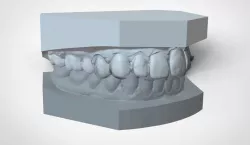 Digital Ortho Mini Deprogrammer Splint 3D print model