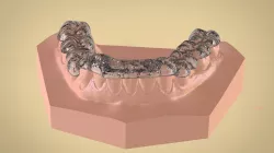 Digital Tanner Ortho Repositioning Splint 3D print model