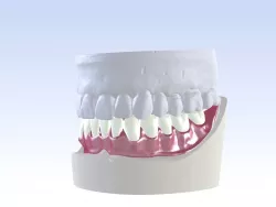 Digital Single Jaw Full Denture 3D print model