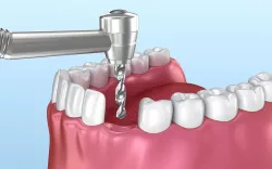 Dental implant animated instalation  3D model