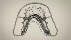 Digital Circumferential Wrap-around Retainer 3D print model