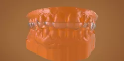 Digital Bite Raising Splint 3D print model
