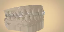 Digital Dental Bite Splint 3D print model