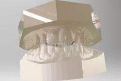 Digital Dental NTI Splint  3D print model