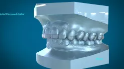 Digital Dental Dayguard Splint 3D print model