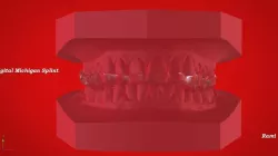 Digital Michigan Splint for 3D Printing 3D print model