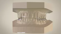 Digital Superior Repositioner Splint 3D print model