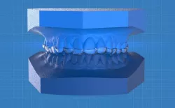 Ortho Anterior Repositioning Splint 3D print model