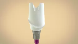 Digital Custom TiBase Abutment 3D print model