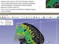 Printable Diffusion MRI analysis Brain tracts