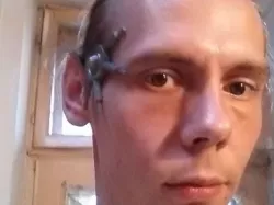 Borg implant