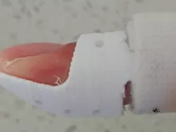 Stack Splint for Mallet Finger Injury