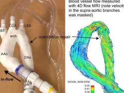 Surgically repaired coarctation of the aorta (flow model)