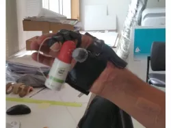 Thumb Prosthesis