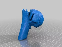 Broken humerus