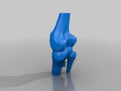 knee-exostose