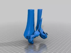 Broken ankle