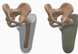 Transfemoral (above-knee) Ischial Containment Prosthetic Socket Pack 1