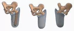 Transfemoral (above-knee) Ischial Containment Prosthetic Socket Pack 2