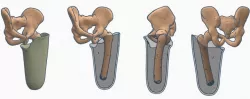 Transfemoral (above-knee) Quadrilateral Prosthetic Socket Pack 1