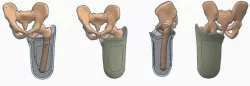 Transfemoral (above-knee) Quadrilateral Prosthetic Socket Pack 2