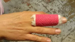 finger splints