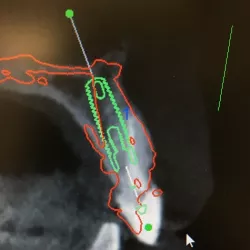 dental implant surgical guide