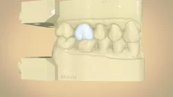 Digital Dental Quadrant Model with a Full Contour Crown