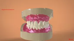 Digital Full Dentures