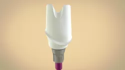 Digital Custom TiBase Abutment