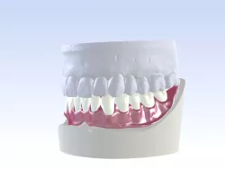 Digital Single Jaw Full Denture