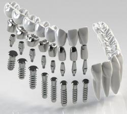 Image showcasing iti implant 3d models 【 STLFinder