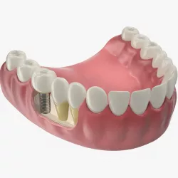 Lower Teeth Medical Model With Dental Implant 3d model