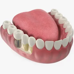 Teeth Tongue Medical Model With Dental Implant 3d model