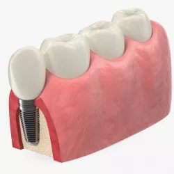 Education Tooth Implant Model 3d model