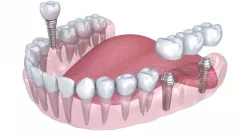 Lower teeth crown and dental implant 3d model