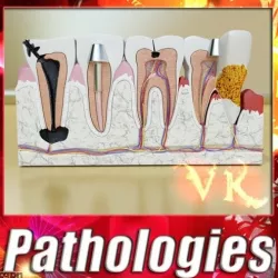 Tooth Pathologies 3d model