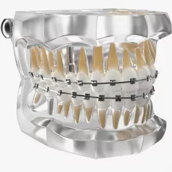 Transparent Dental Typodont With Bracket and Dental Implants 3d model