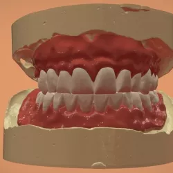 Digital Complete Dentures