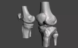 Knee joint - male - age 64 3D model