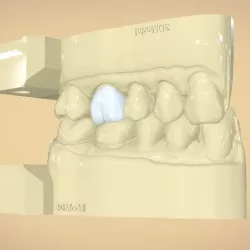 Digital Dental Quadrant  Model with a Full Contour Crown