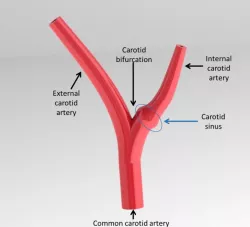 Carotid sinus