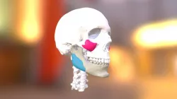 Jaw Surgery + Facial Implants (Finish)