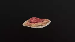 Kidney Tumor 1