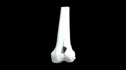 Left Femur with Gunshot Wound (VCU_3D_5402)