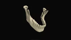 Mandible (CT Scan)