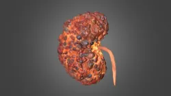 Polycystic Kidney